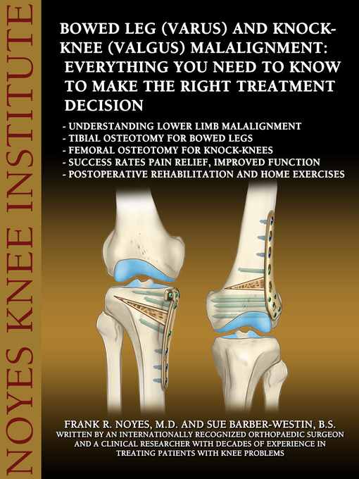 Upplýsingar um Bowed Leg (Varus) and Knock-Knee (Valgus) Malalignment eftir Frank R. Noyes, M.D. - Biðlisti